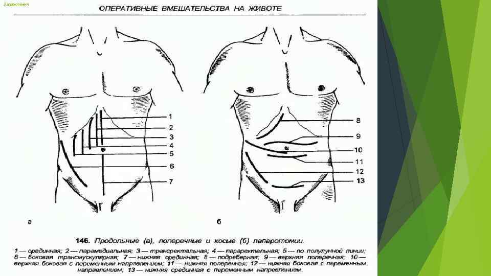 Лапаротомия 