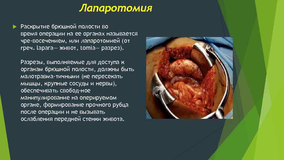 Лапаротомия Раскрытие брюшной полости во время операции на ее органах называется чре восечением, или