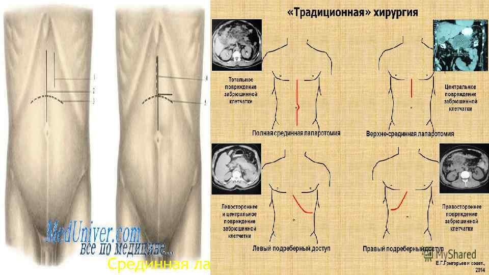 Срединная лапаротомия 