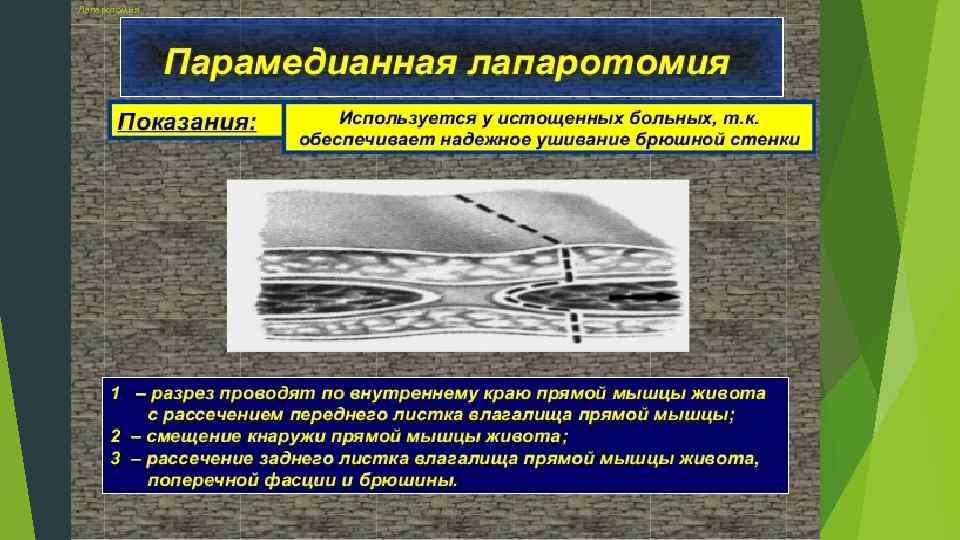 Лапаротомия 