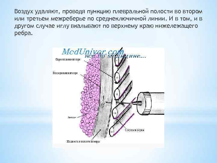 Воздух удаляют, проводя пункцию плевральной полости во втором или третьем межреберье по среднеключичной линии.