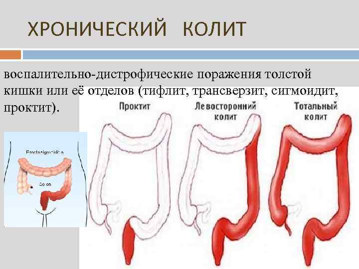 ХРОНИЧЕСКИЙ КОЛИТ воспалительно-дистрофические поражения толстой кишки или её отделов (тифлит, трансверзит, сигмоидит, проктит). 