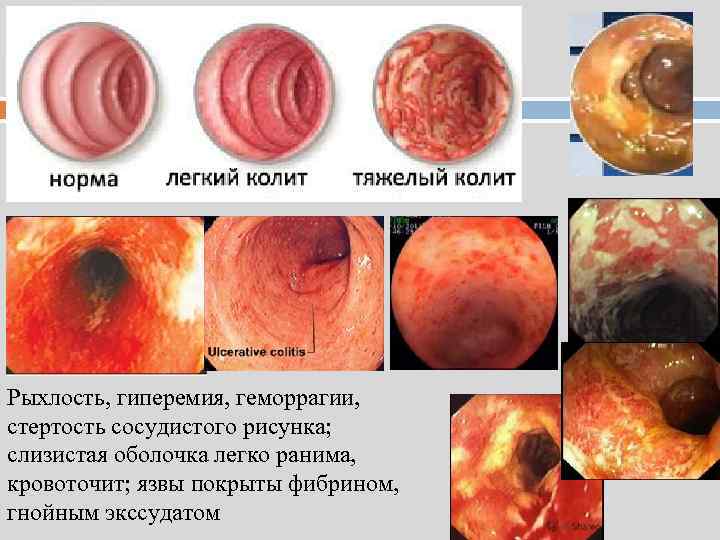Рыхлость, гиперемия, геморрагии, стертость сосудистого рисунка; слизистая оболочка легко ранима, кровоточит; язвы покрыты фибрином,