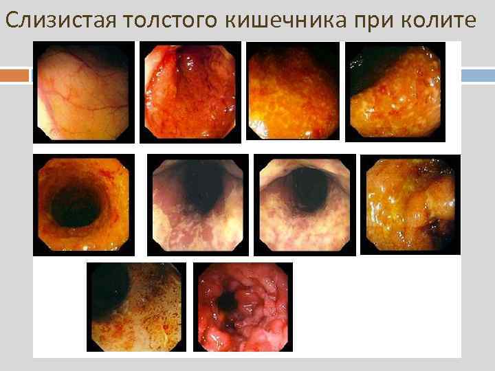 Слизистая толстого кишечника при колите 