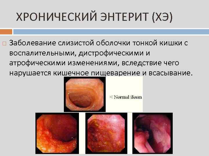 ХРОНИЧЕСКИЙ ЭНТЕРИТ (ХЭ) Заболевание слизистой оболочки тонкой кишки с воспалительными, дистрофическими и атрофическими изменениями,