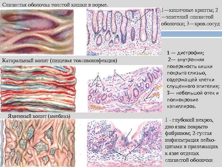 Слизистая оболочка толстой кишки в норме. Катаральный колит (пищевая токсикоинфекция) Язвенный колит (амебиаз) 1—кишечные