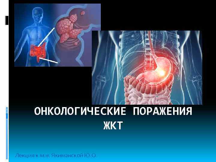 ОНКОЛОГИЧЕСКИЕ ПОРАЖЕНИЯ ЖКТ Лекция к. м. н. Якиманской Ю. О. 