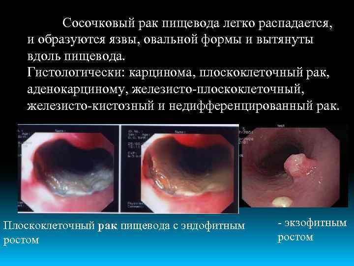 Сосочковый рак пищевода легко распадается, и образуются язвы, овальной формы и вытянуты вдоль пищевода.