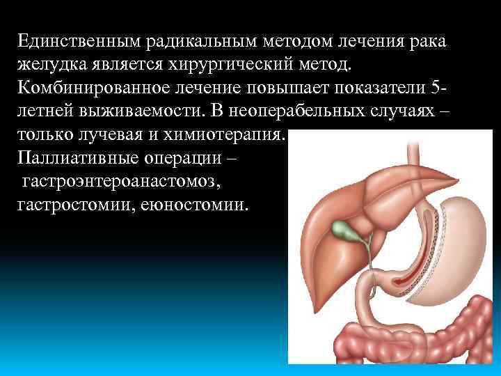 Единственным радикальным методом лечения рака желудка является хирургический метод. Комбинированное лечение повышает показатели 5