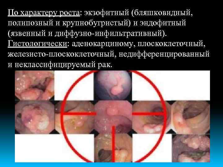 По характеру роста: экзофитный (бляшковидный, полипозный и крупнобугристый) и эндофитный (язвенный и диффузно-инфильтративный). Гистологически: