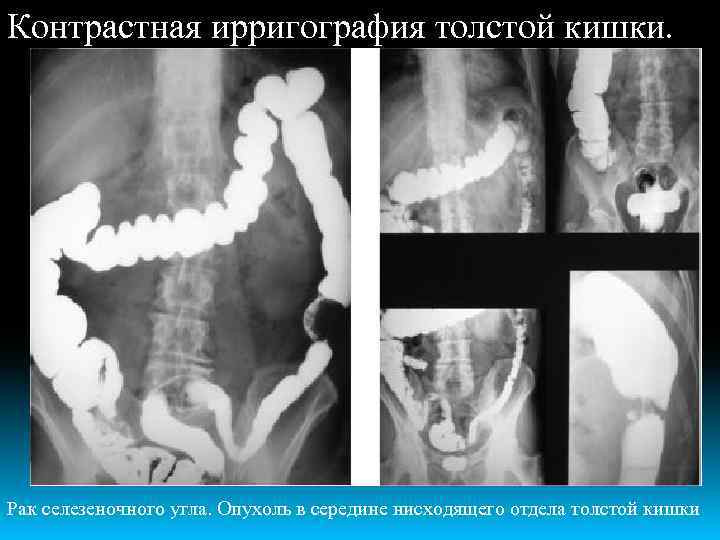 Контрастная ирригография толстой кишки. Рак селезеночного угла. Опухоль в середине нисходящего отдела толстой кишки