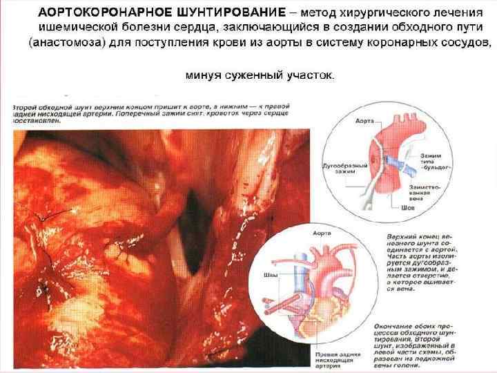 Атеросклероз ибс инфаркт миокарда