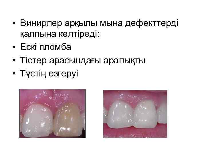  • Винирлер арқылы мына дефекттерді қалпына келтіреді: • Ескі пломба • Тістер арасындағы