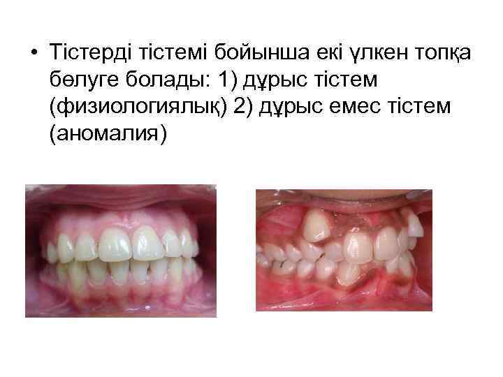  • Тістерді тістемі бойынша екі үлкен топқа бөлуге болады: 1) дұрыс тістем (физиологиялық)