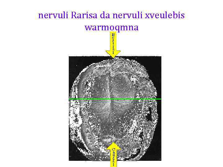 nervuli Rarisa da nervuli xveulebis warmoqmna 