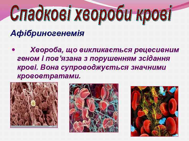 Афібриногенемія Хвороба, що викликається рецесивним геном і пов’язана з порушенням зсідання крові. Вона супроводжується