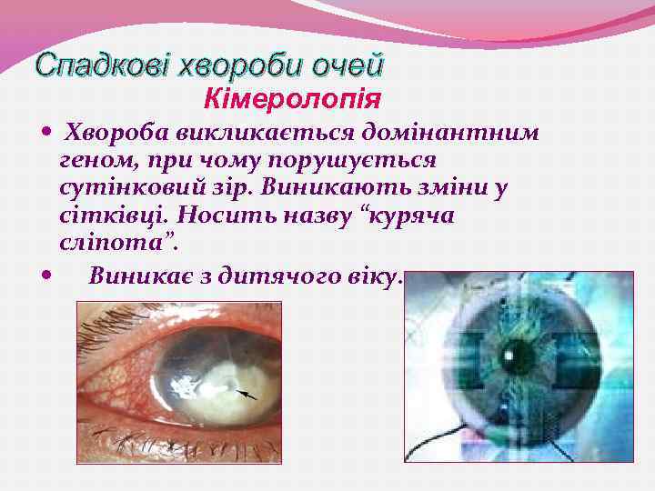 Спадкові хвороби очей Кімеролопія Хвороба викликається домінантним геном, при чому порушується сутінковий зір. Виникають