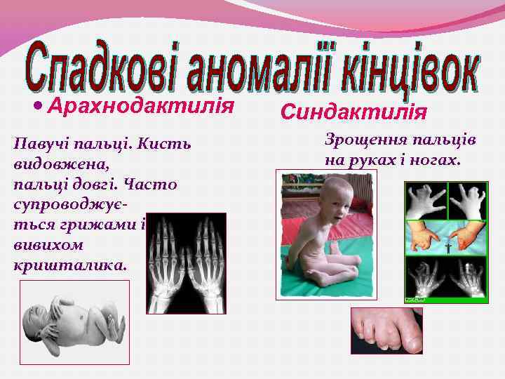  Арахнодактилія Павучі пальці. Кисть видовжена, пальці довгі. Часто супроводжується грижами і вивихом кришталика.