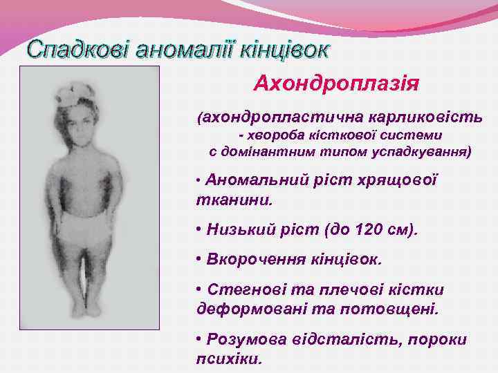 Спадкові аномалії кінцівок Ахондроплазія (ахондропластична карликовість - хвороба кісткової системи с домінантним типом успадкування)