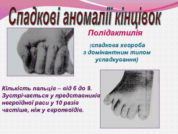Полідактилія (спадкова хвороба з домінантним типом успадкування) Кількість пальців – від 6 до 9.