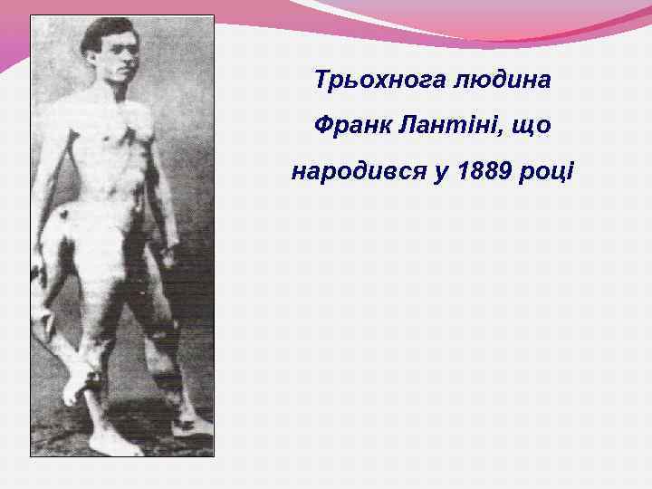 Трьохнога людина Франк Лантіні, що народився у 1889 році 