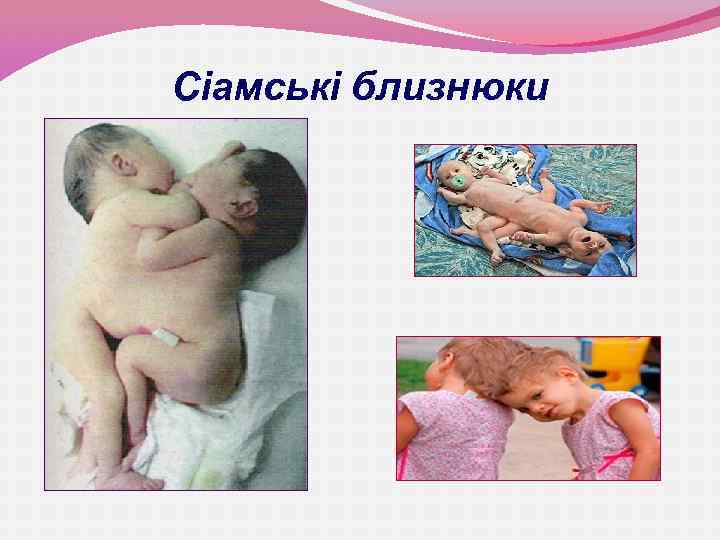 Сіамські близнюки 