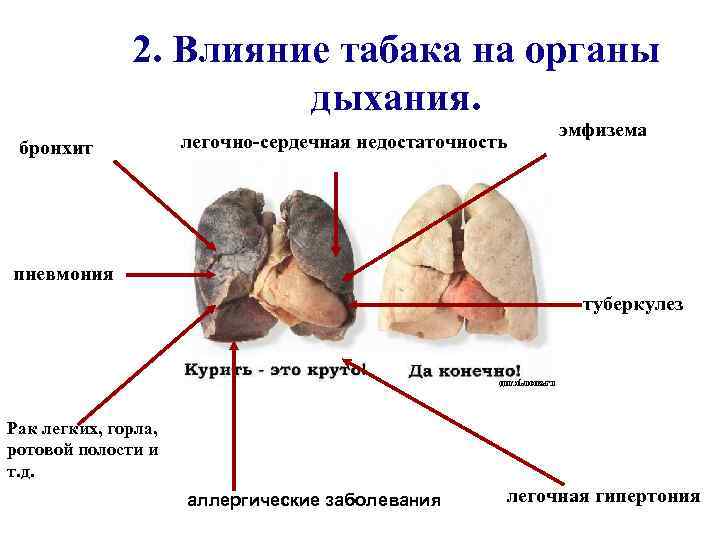 2. Влияние табака на органы дыхания. бронхит легочно-сердечная недостаточность эмфизема пневмония туберкулез Рак легких,