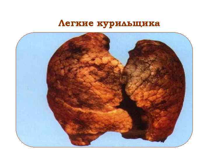 Легкие курильщика 