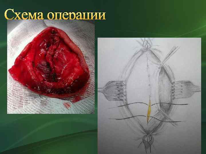 Схема операции 
