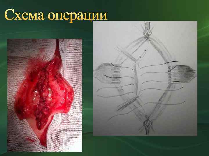 Схема операции 
