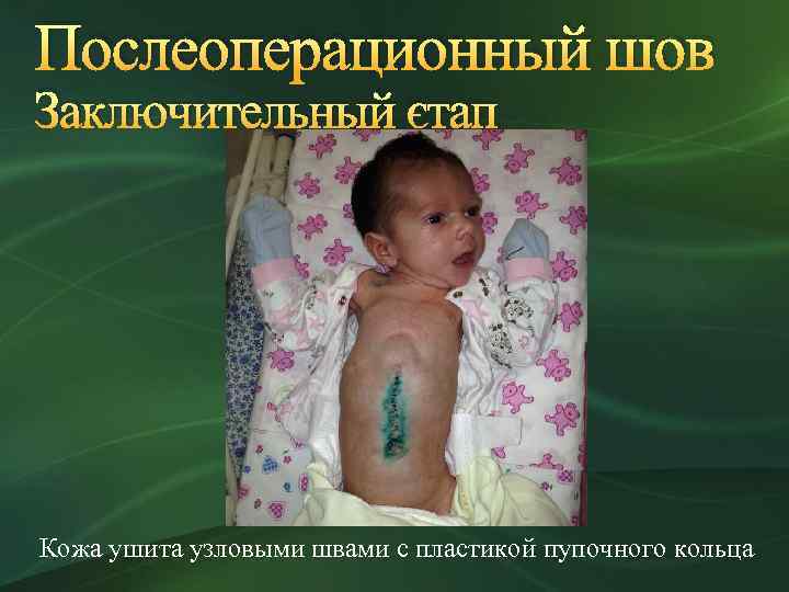 Послеоперационный шов Заключительный этап Кожа ушита узловыми швами с пластикой пупочного кольца 