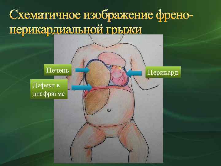 Схематичное изображение френоперикардиальной грыжи Печень Дефект в диафрагме Перикард 