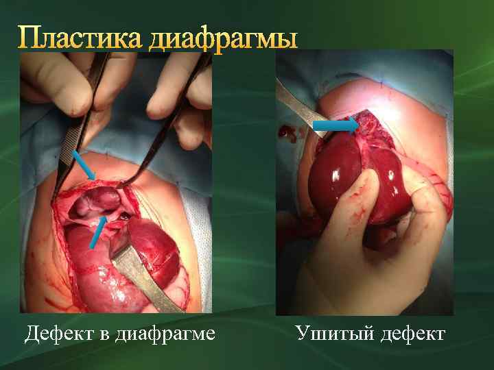 Пластика диафрагмы Дефект в диафрагме Ушитый дефект 