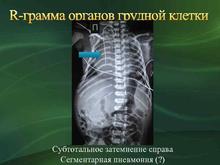 R-грамма органов грудной клетки Субтотальное затемнение справа Сегментарная пневмония (? ) 