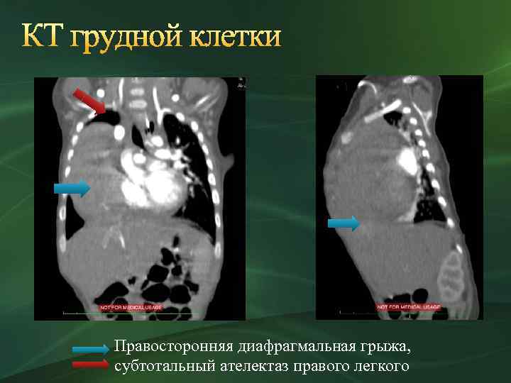 КТ грудной клетки Правосторонняя диафрагмальная грыжа, субтотальный ателектаз правого легкого 