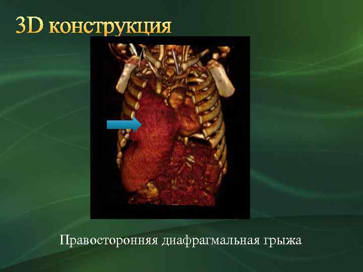3 D конструкция Правосторонняя диафрагмальная грыжа 
