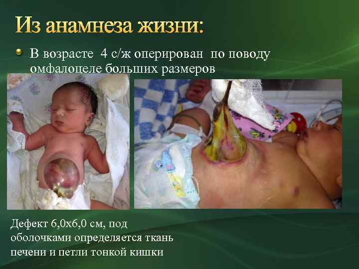 Из анамнеза жизни: В возрасте 4 с/ж оперирован по поводу омфалоцеле больших размеров Дефект