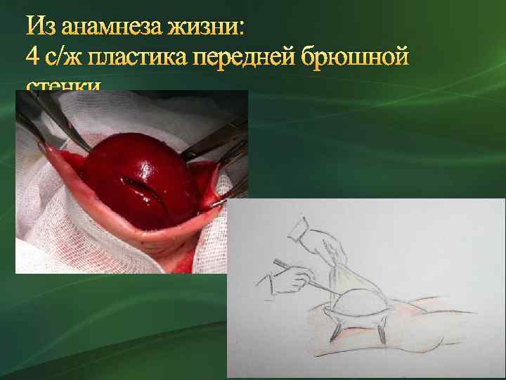 Из анамнеза жизни: 4 с/ж пластика передней брюшной стенки 