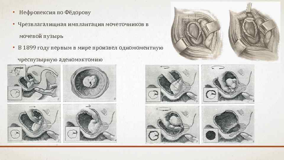 Нефропексия это