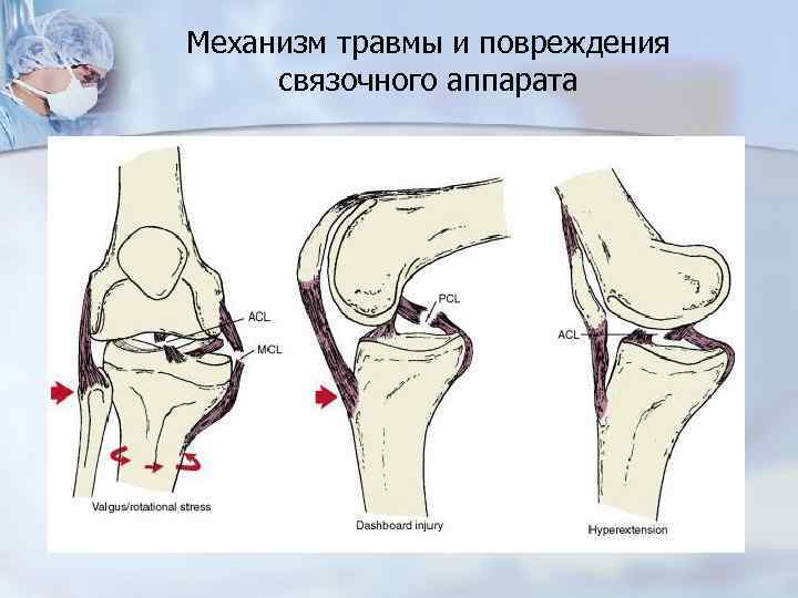 Растяжение связок коленного сустава картинки