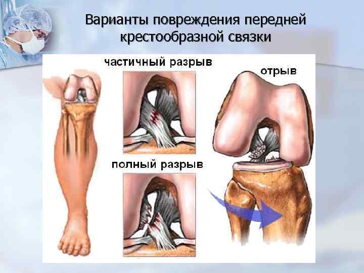 Варианты повреждения передней крестообразной связки 