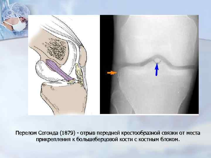 Перелом Сегонда (1879) - отрыв передней крестообразной связки от места прикрепления к большеберцовой кости