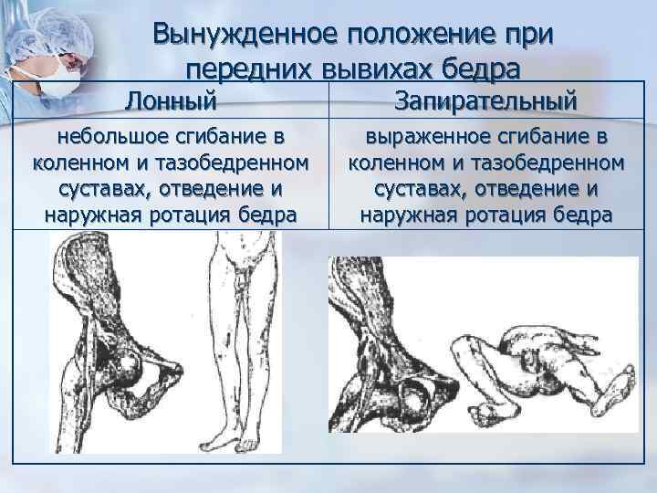 Рентгеновская картина переломов и вывихов костей