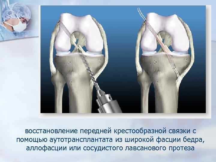 После пластики передней крестообразной связки