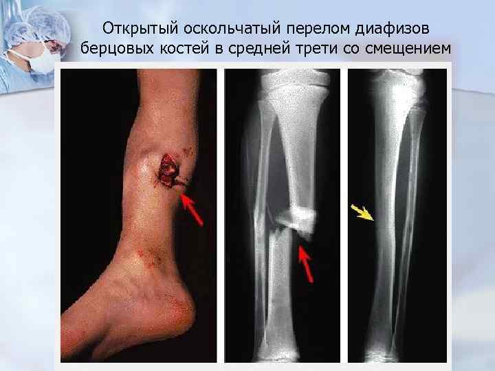 Открытый оскольчатый перелом диафизов берцовых костей в средней трети со смещением 