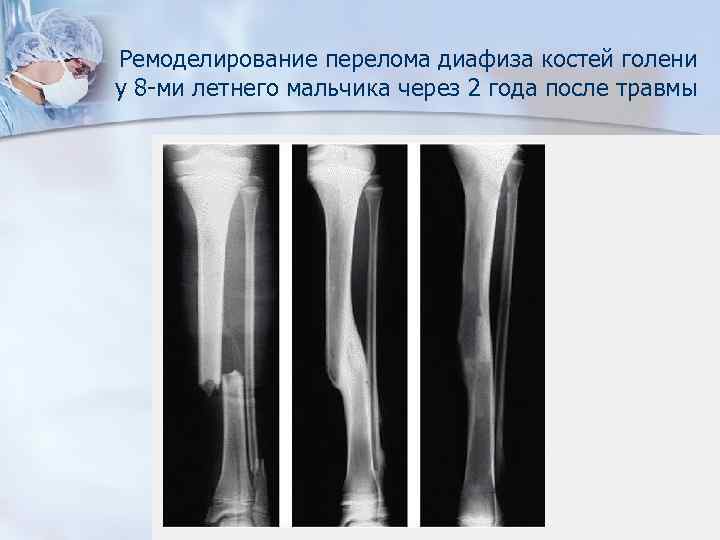 Перелом берцовой кости ребенка