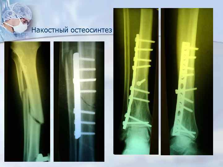 Пластина после. Экстракортикальный остеосинтез. Накостный остеосинтез рентгенограмма. Экстрамедуллярный (накостный) остеосинтез. Перелом большеберцовой кости экстрамедуллярный остеосинтез.