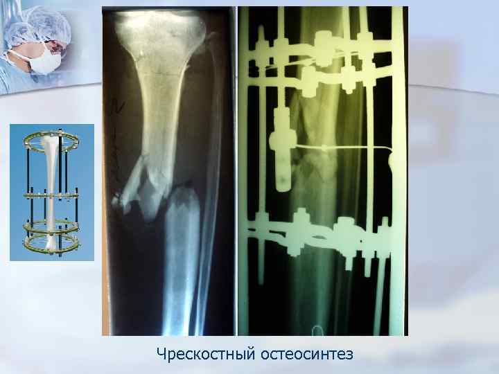 Внеочаговый остеосинтез презентация