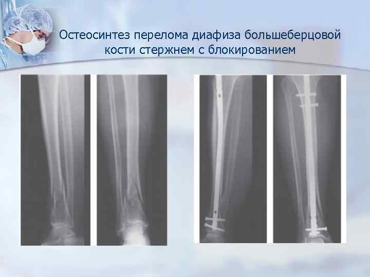 Закрытый перелом большеберцовой кости со смещением. Остеосинтез диафиза большеберцовой кости. Винтообразный перелом большеберцовой кости остеосинтез. Интрамедуллярный остеосинтез большеберцовой и малоберцовой кости. Изолированные переломы диафиза большеберцовой кости.