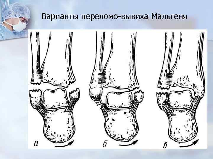 Трехлодыжечный перелом схема